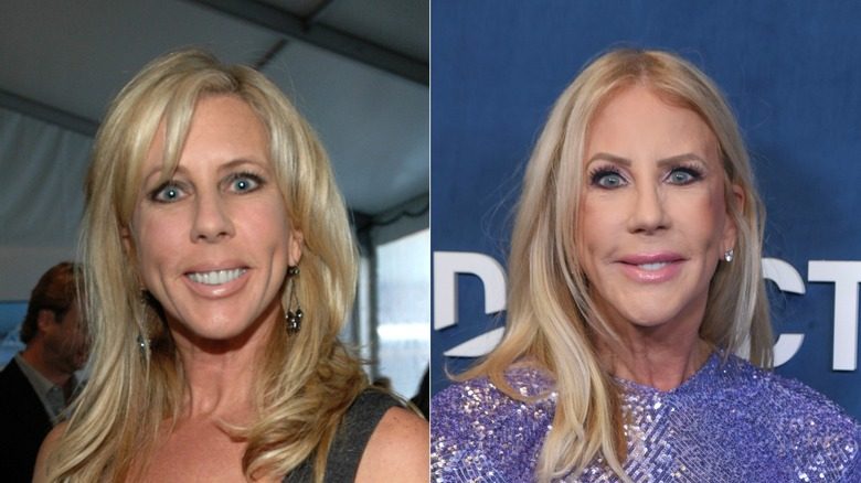 Vicki Gunvalson souriant avant et après les ajustements du visage