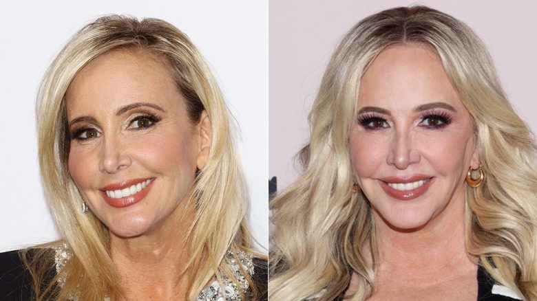 Shannon Beador souriant avant et après son lifting