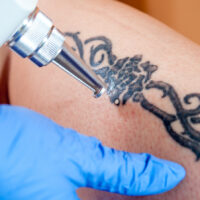 Les millennials adoraient les tatouages ​​– ils font désormais du retrait au laser la prochaine grande tendance