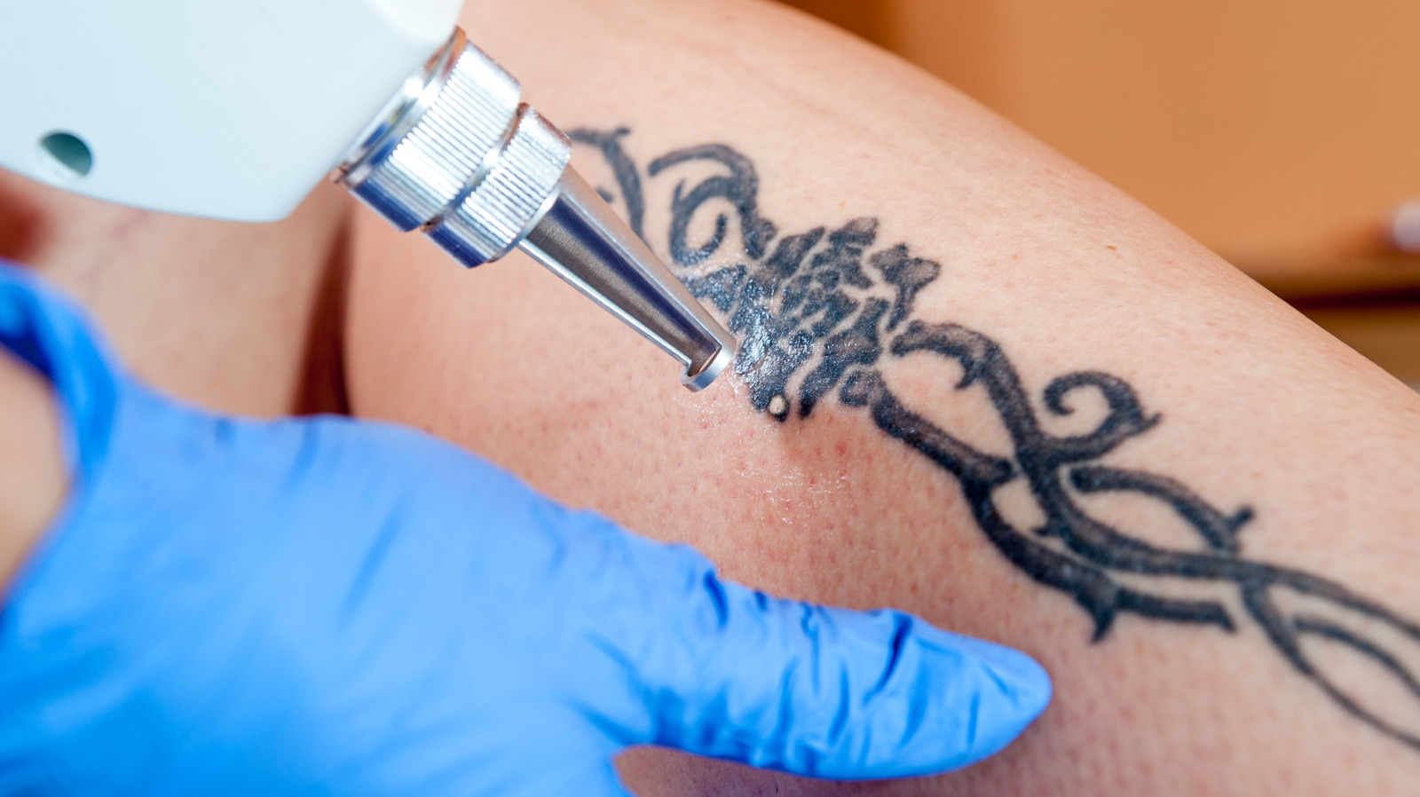 Les millennials adoraient les tatouages ​​– ils font désormais du retrait au laser la prochaine grande tendance
